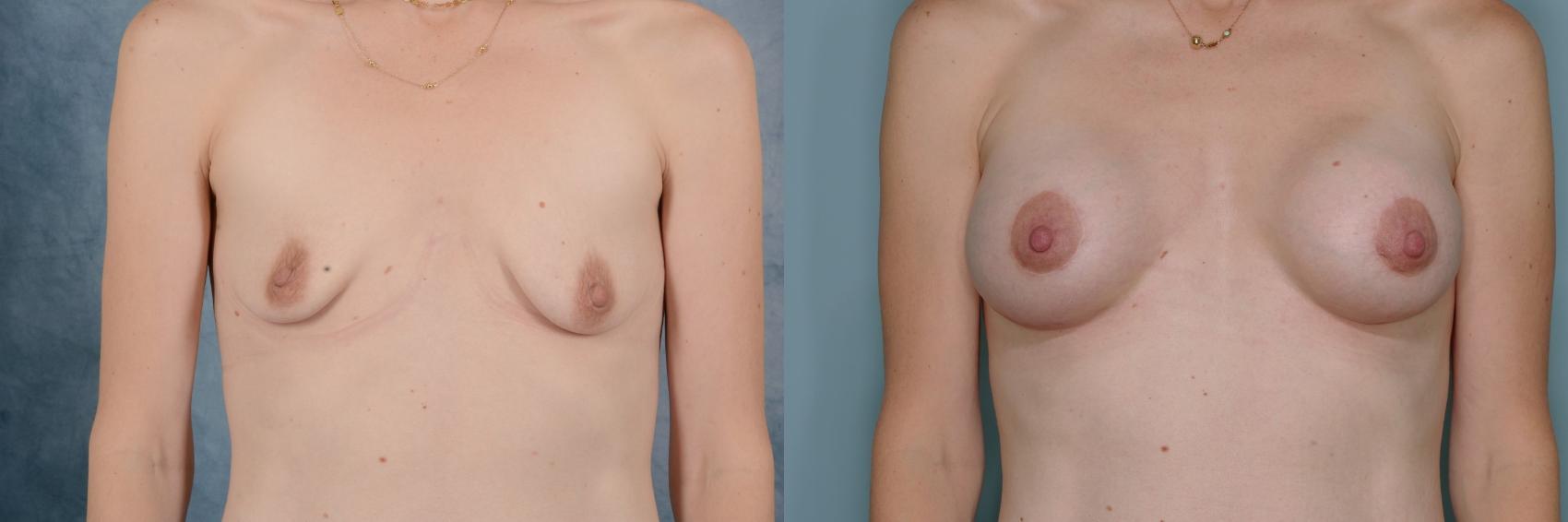 Before & After Breast Lift (Mastopexy) with Implants Case 653 Front View in Tallahassee, FL