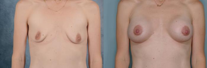 Before & After Breast Lift (Mastopexy) with Implants Case 653 Front View in Tallahassee, FL