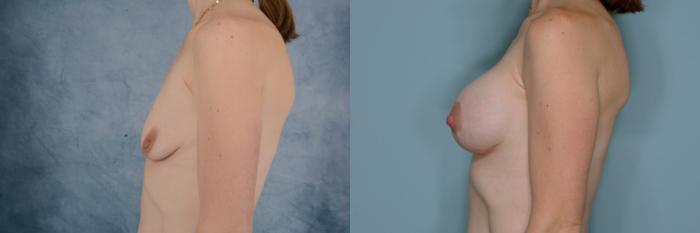 Before & After Breast Lift (Mastopexy) with Implants Case 653 Left Side View in Tallahassee, FL