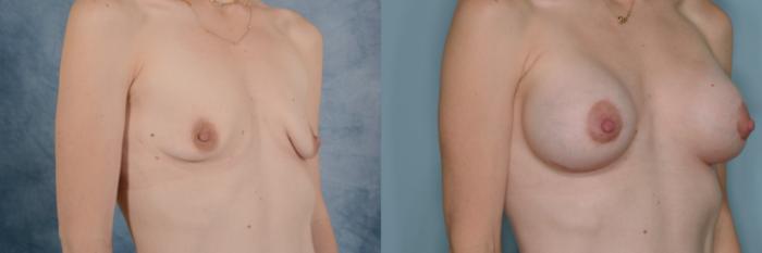 Before & After Breast Lift (Mastopexy) with Implants Case 653 Right Side View in Tallahassee, FL