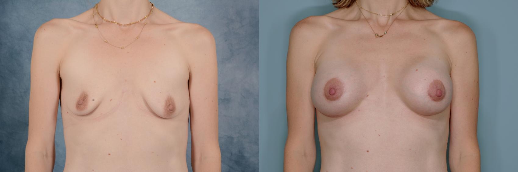 Before & After Breast Lift (Mastopexy) with Implants Case 690 Front View in Tallahassee, FL