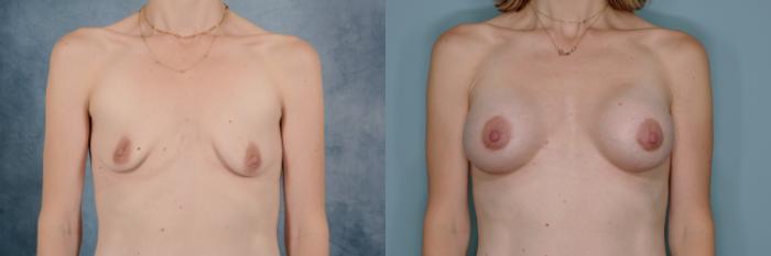 Before & After Breast Lift (Mastopexy) with Implants Case 690 Front View in Tallahassee, FL