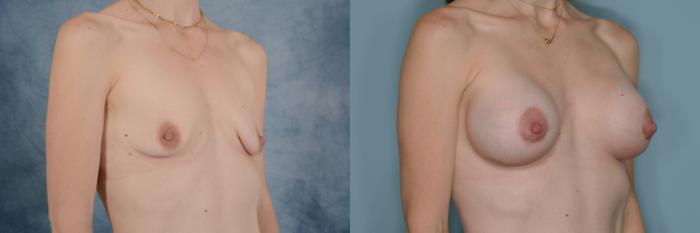 Before & After Breast Lift (Mastopexy) with Implants Case 690 Right Oblique View in Tallahassee, FL