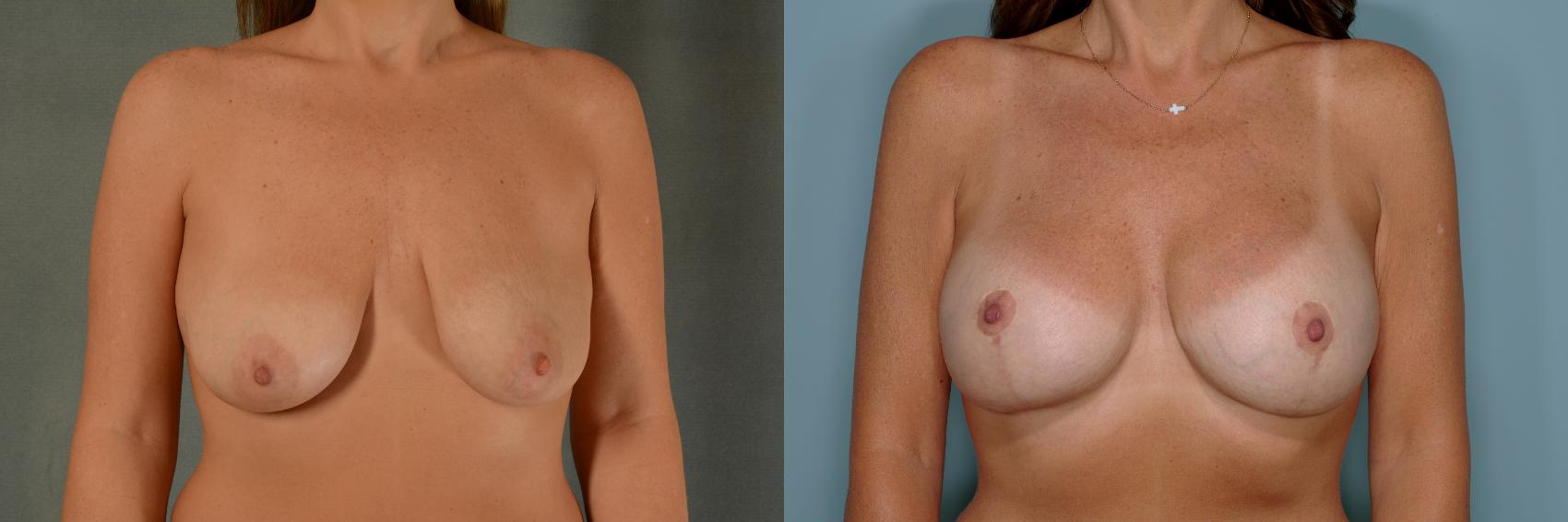 Before & After Breast Lift (Mastopexy) with Implants Case 737 Front View in Tallahassee, FL