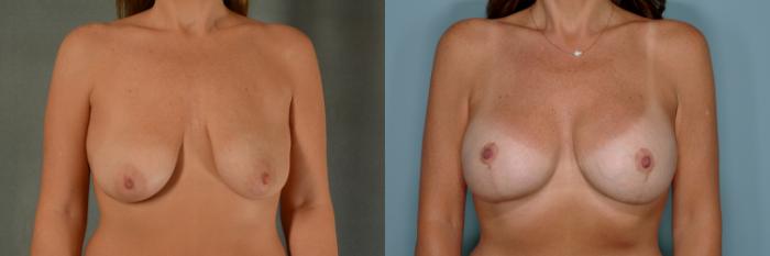 Before & After Breast Lift (Mastopexy) with Implants Case 737 Front View in Tallahassee, FL