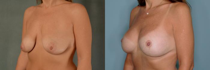 Before & After Breast Lift (Mastopexy) with Implants Case 737 Left Oblique View in Tallahassee, FL