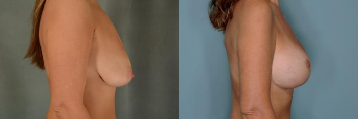 Before & After Breast Lift (Mastopexy) with Implants Case 737 Right Side View in Tallahassee, FL