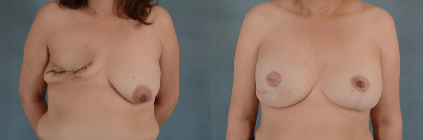 Before & After Breast Reconstruction Case 146 View #1 View in Tallahassee, FL