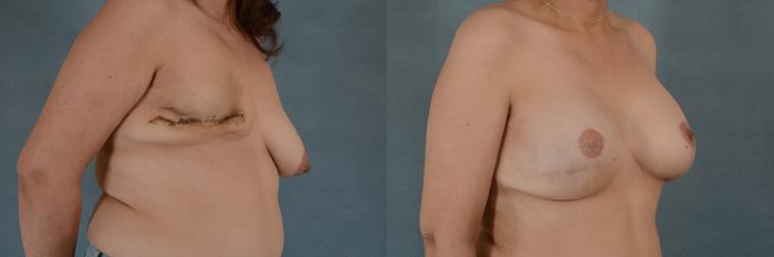 Before & After Breast Reconstruction Case 146 View #2 View in Tallahassee, FL