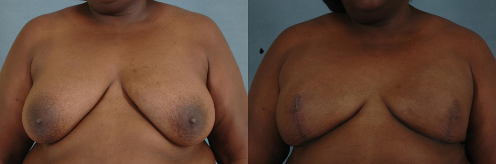 Before & After Breast Reconstruction Case 147 View #1 View in Tallahassee, FL