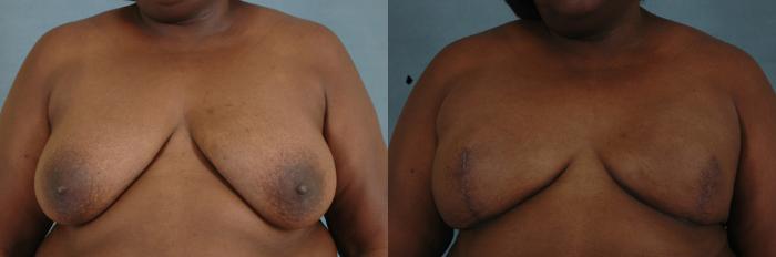 Before & After Breast Reconstruction Case 147 View #1 View in Tallahassee, FL
