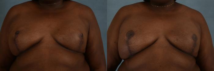 Before & After Breast Reconstruction Case 147 View #2 View in Tallahassee, FL