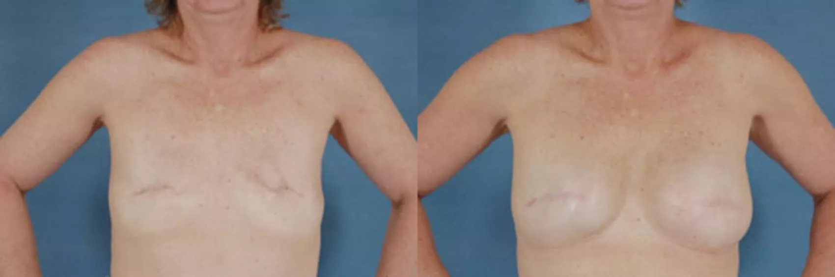 Surgeons repair woman's 'crooked breasts' following a double mastectomy
