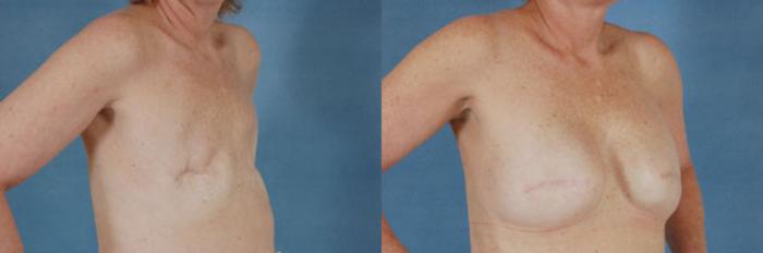 Before & After Breast Reconstruction Case 148 View #2 View in Tallahassee, FL
