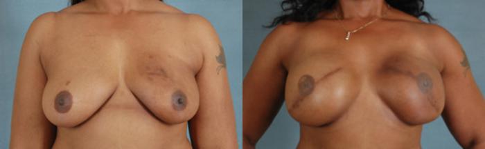 Before & After Breast Reconstruction Case 149 View #1 View in Tallahassee, FL