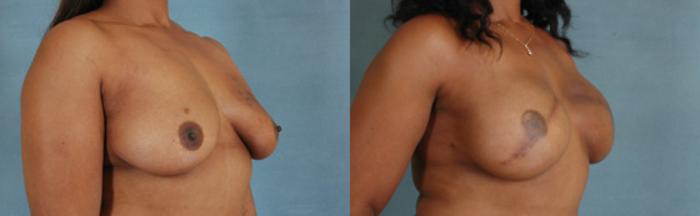Before & After Breast Reconstruction Case 149 View #2 View in Tallahassee, FL