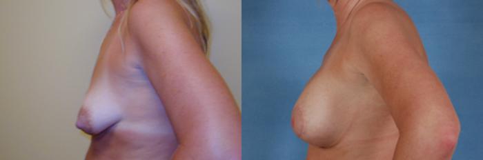 Before & After Breast Reconstruction Case 150 View #4 View in Tallahassee, FL
