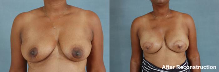 Before & After Breast Reconstruction Case 153 View #1 View in Tallahassee, FL