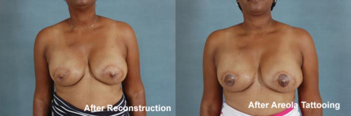 Before & After Breast Reconstruction Case 153 View #2 View in Tallahassee, FL