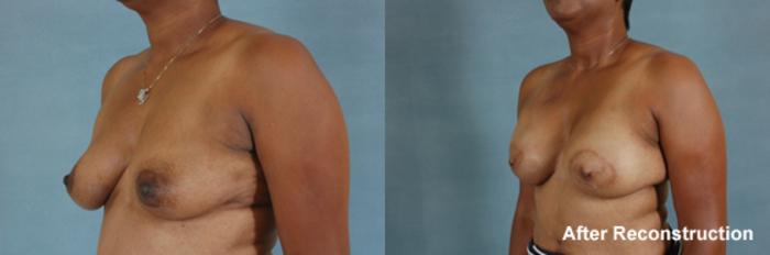 Before & After Breast Reconstruction Case 153 View #3 View in Tallahassee, FL