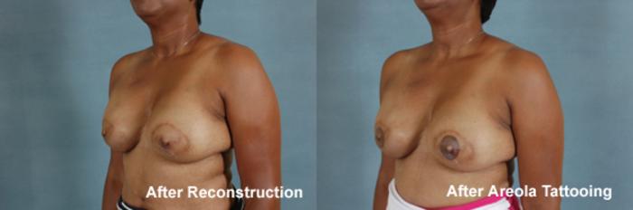 Before & After Breast Reconstruction Case 153 View #4 View in Tallahassee, FL