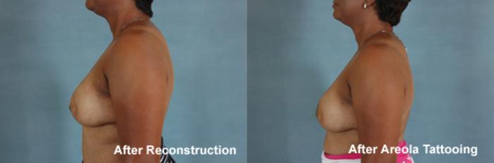 Before & After Breast Reconstruction Case 153 View #6 View in Tallahassee, FL
