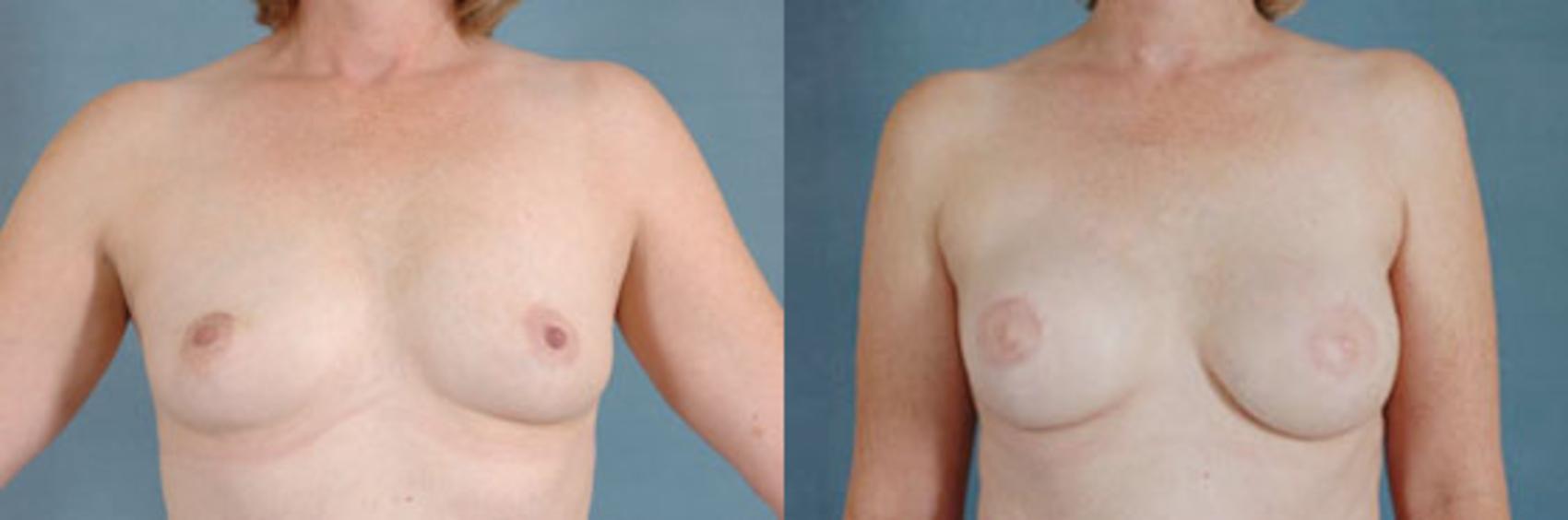 Before & After Breast Reconstruction Case 154 View #1 View in Tallahassee, FL
