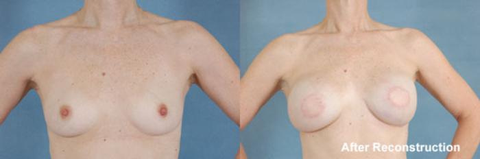 Before & After Breast Reconstruction Case 155 View #1 View in Tallahassee, FL