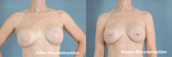 Before & After Breast Reconstruction Case 155 View #2 View in Tallahassee, FL