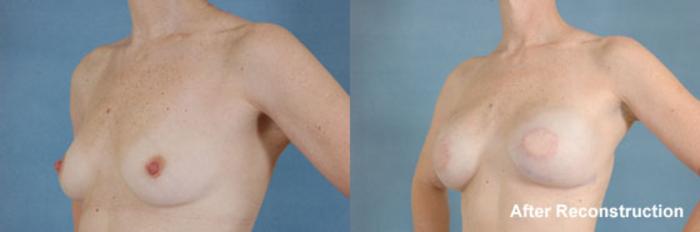 Before & After Breast Reconstruction Case 155 View #3 View in Tallahassee, FL