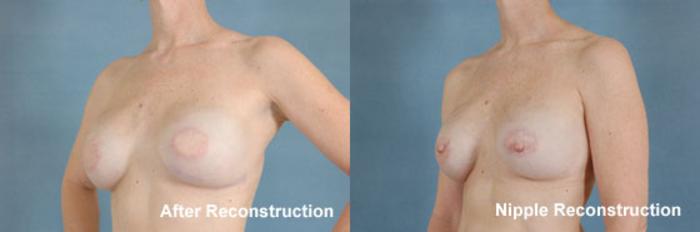 Before & After Breast Reconstruction Case 155 View #4 View in Tallahassee, FL