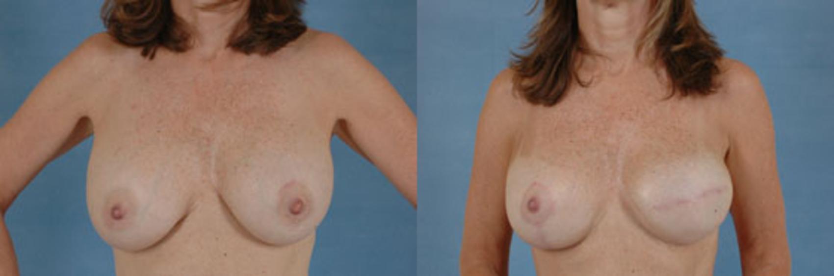 Before & After Breast Reconstruction Case 156 View #1 View in Tallahassee, FL