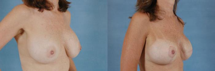 Before & After Breast Reconstruction Case 156 View #2 View in Tallahassee, FL
