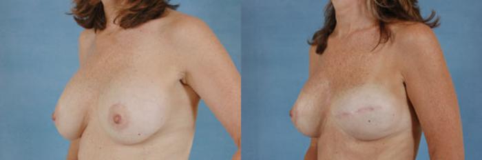 Before & After Breast Reconstruction Case 156 View #3 View in Tallahassee, FL
