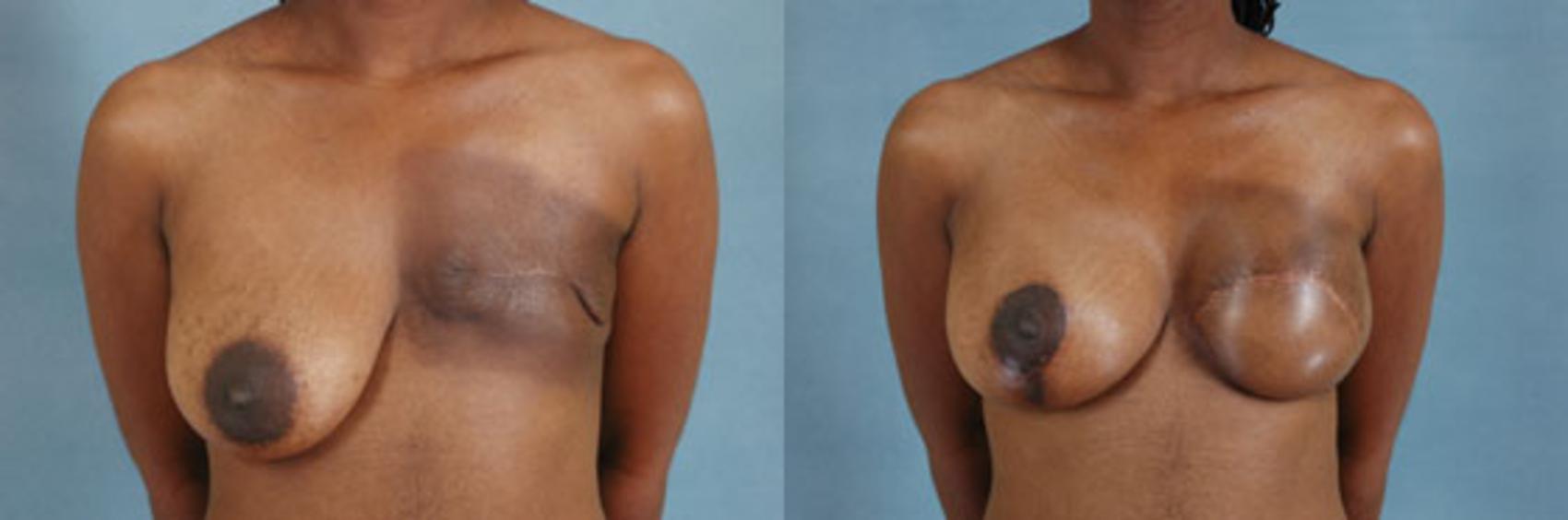 Before & After Breast Reconstruction Case 157 View #1 View in Tallahassee, FL
