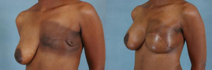 Before & After Breast Reconstruction Case 157 View #2 View in Tallahassee, FL