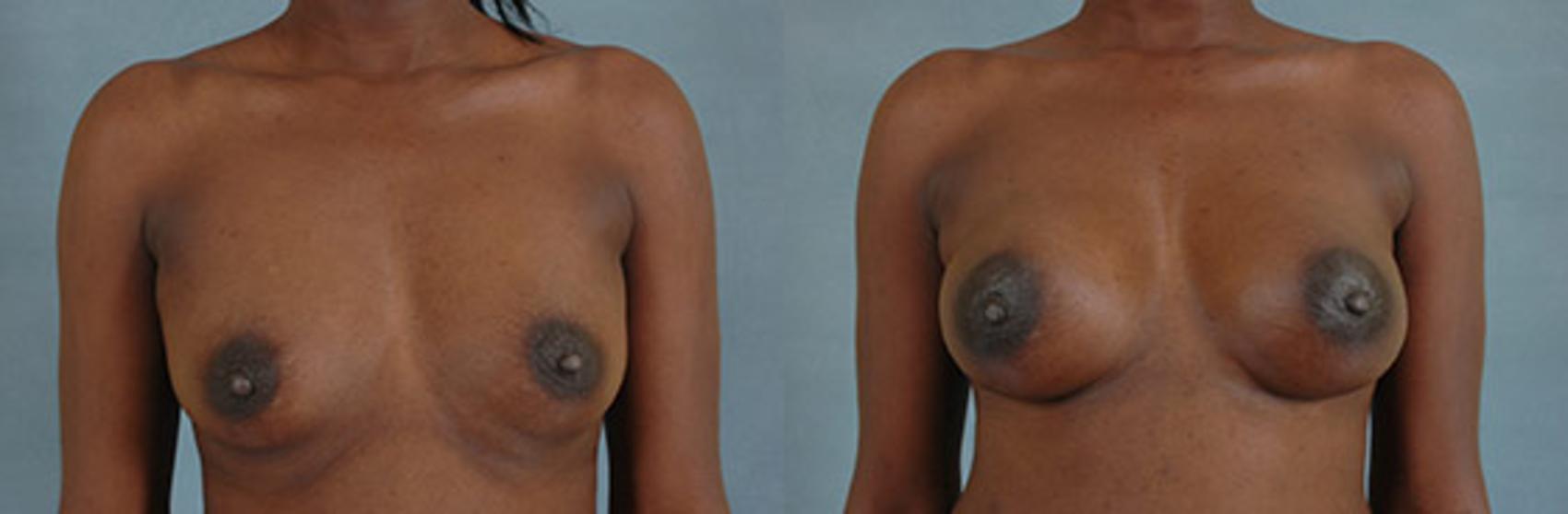 Before & After Breast Reconstruction Case 158 View #1 View in Tallahassee, FL