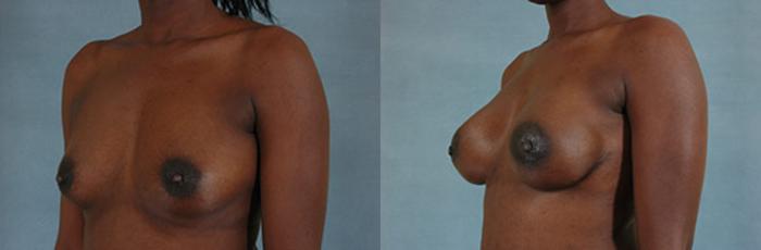 Before & After Breast Reconstruction Case 158 View #2 View in Tallahassee, FL