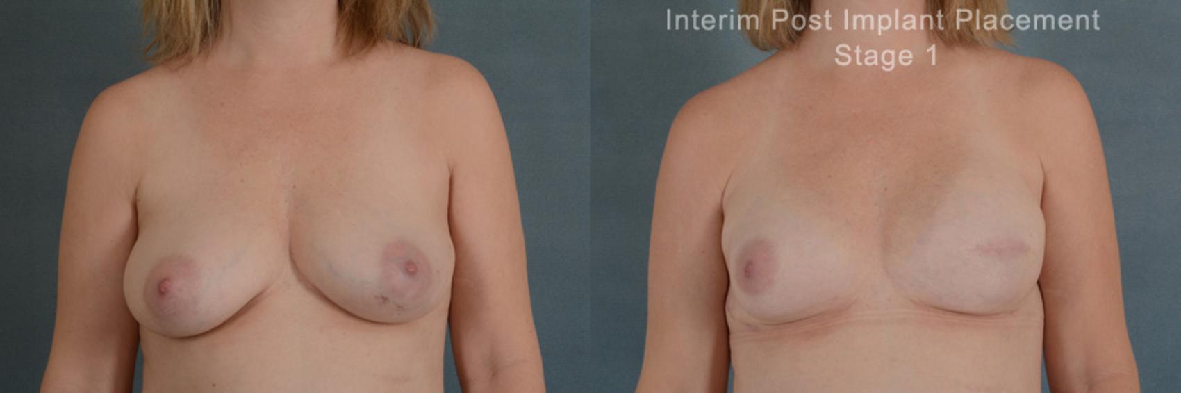 Before & After Breast Reconstruction Case 159 View #1 View in Tallahassee, FL