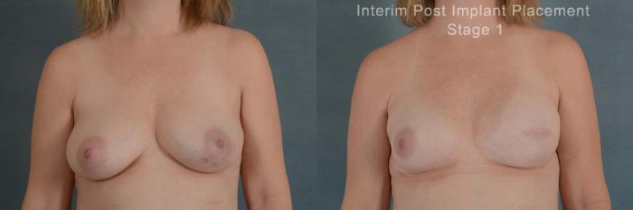 Before & After Breast Reconstruction Case 159 View #1 View in Tallahassee, FL