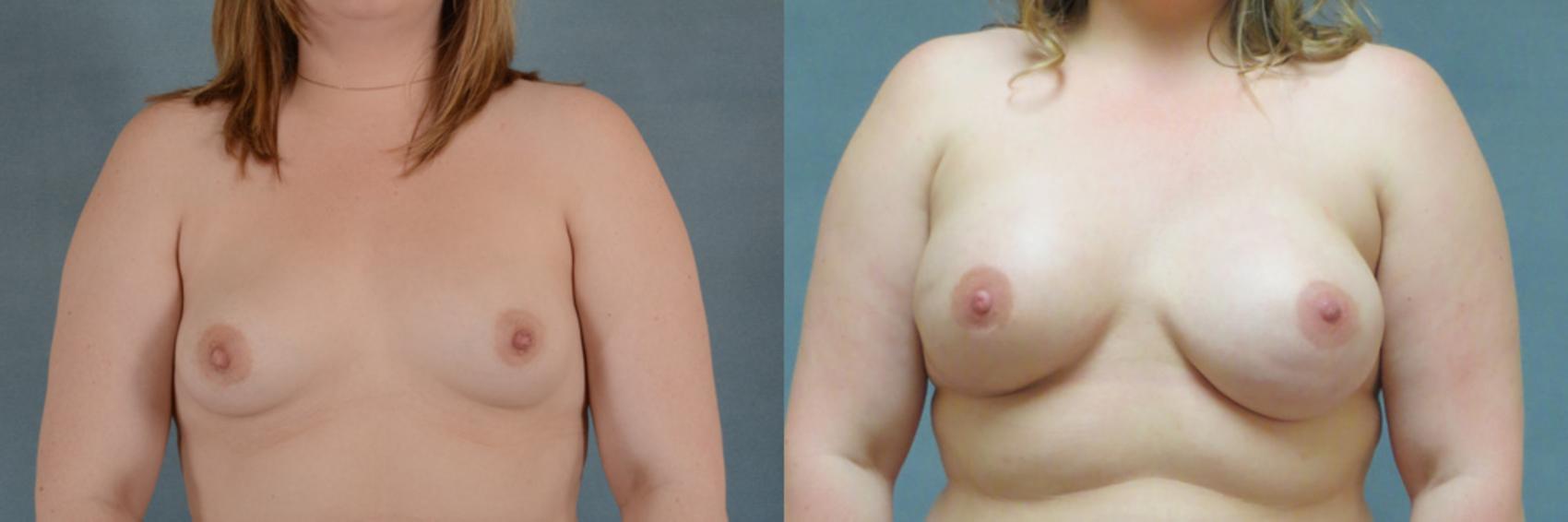 Before & After Breast Reconstruction Case 160 View #1 View in Tallahassee, FL