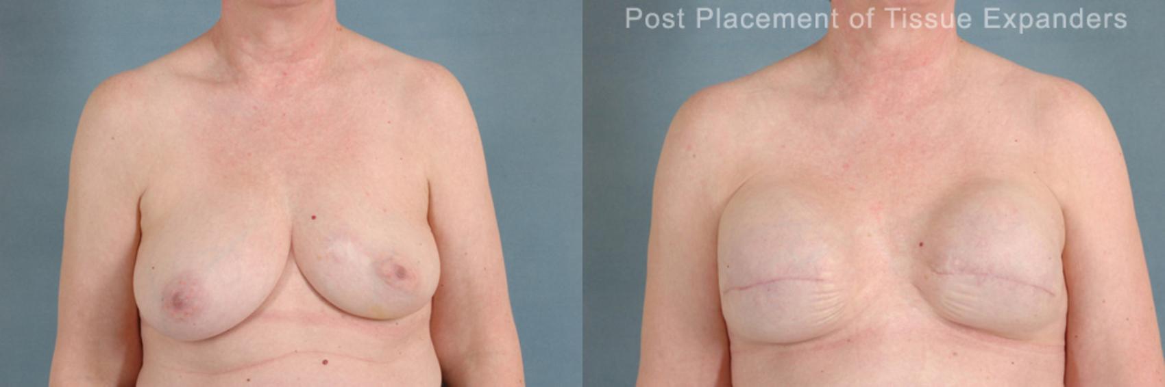 Before & After Breast Reconstruction Case 161 View #1 View in Tallahassee, FL