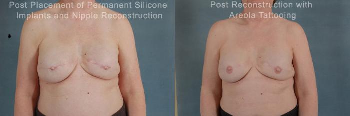 Before & After Breast Reconstruction Case 161 View #2 View in Tallahassee, FL