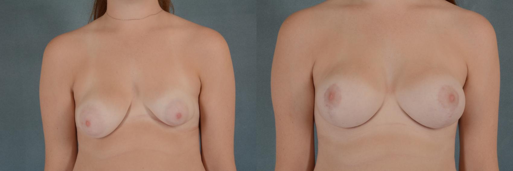 Before & After Breast Reconstruction Case 280 View #1 View in Tallahassee, FL