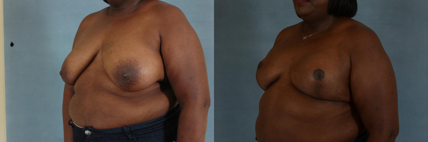 Breast Reconstruction Before and After Pictures Case 350, Tallahassee, FL