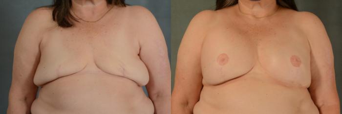Before & After Breast Reconstruction Case 495 Front View in Tallahassee, FL