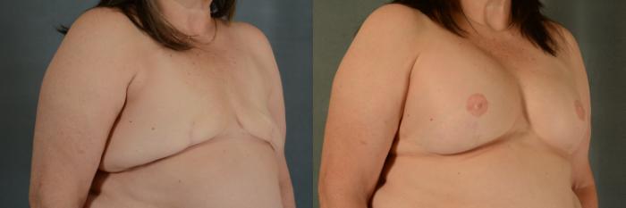Before & After Breast Reconstruction Case 495 Right Oblique View in Tallahassee, FL
