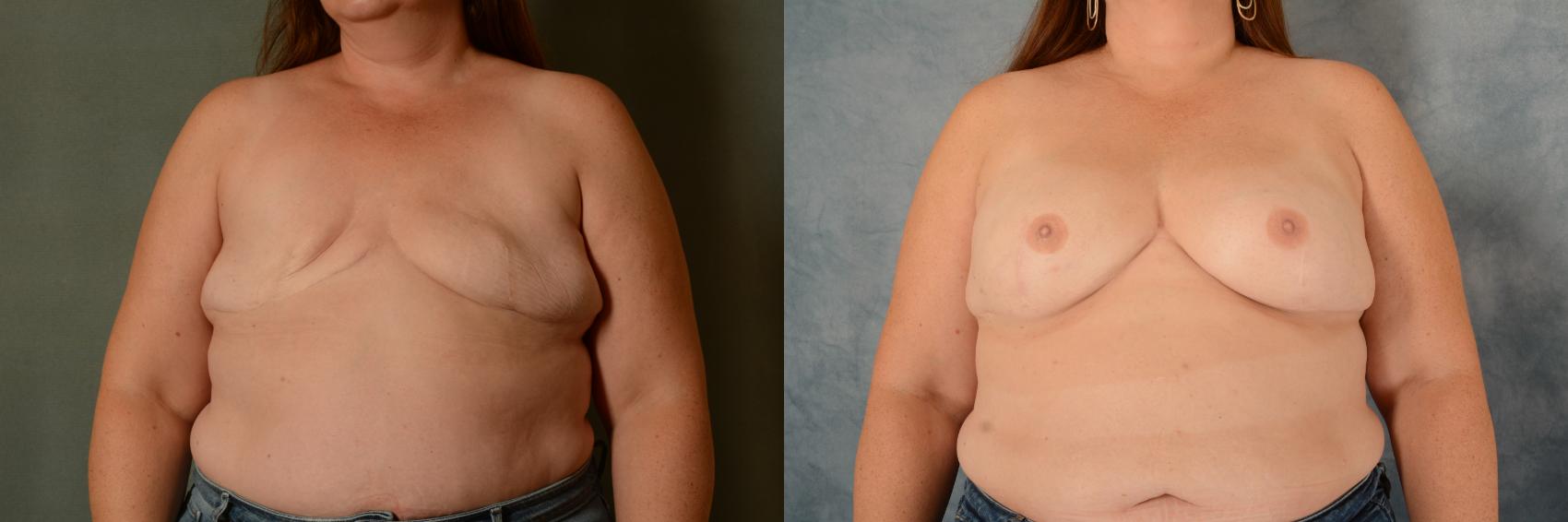 Before & After Breast Reconstruction Case 582 Front View in Tallahassee, FL