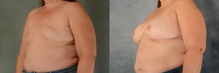 Before & After Breast Reconstruction Case 582 Left Oblique View in Tallahassee, FL