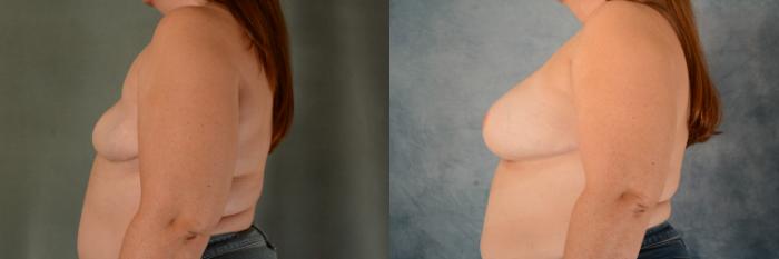 Before & After Breast Reconstruction Case 582 Left Side View in Tallahassee, FL